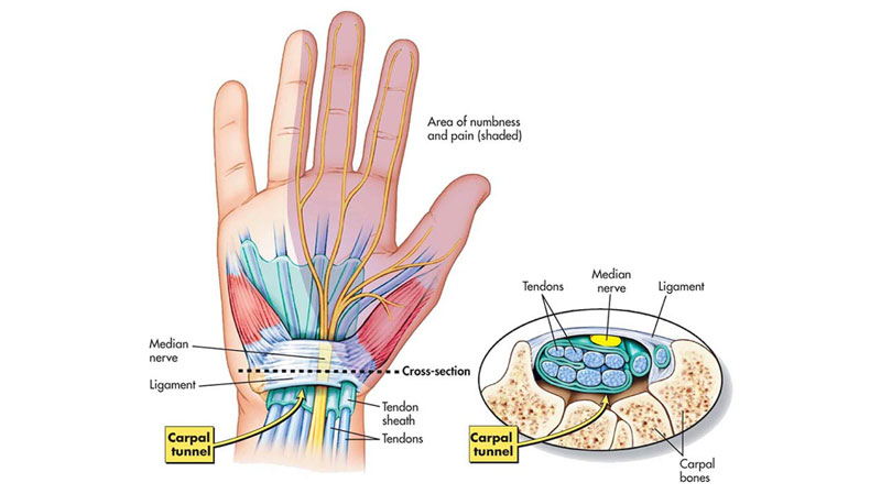 carpal tunnel image