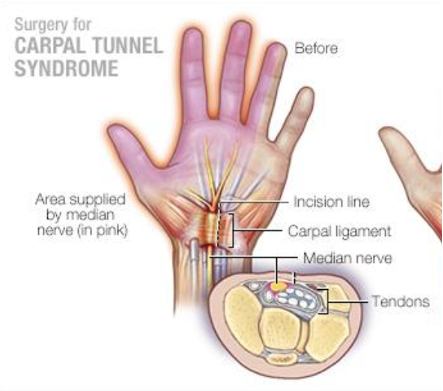 Photo: Carpal Tunnel Syndrome