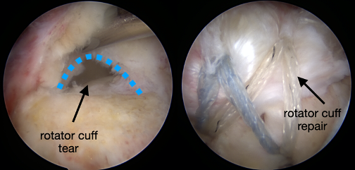 Photo: Rotator Cuff