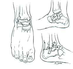 Ankle Sprain