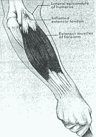 Photo: Elbow Tendinitis