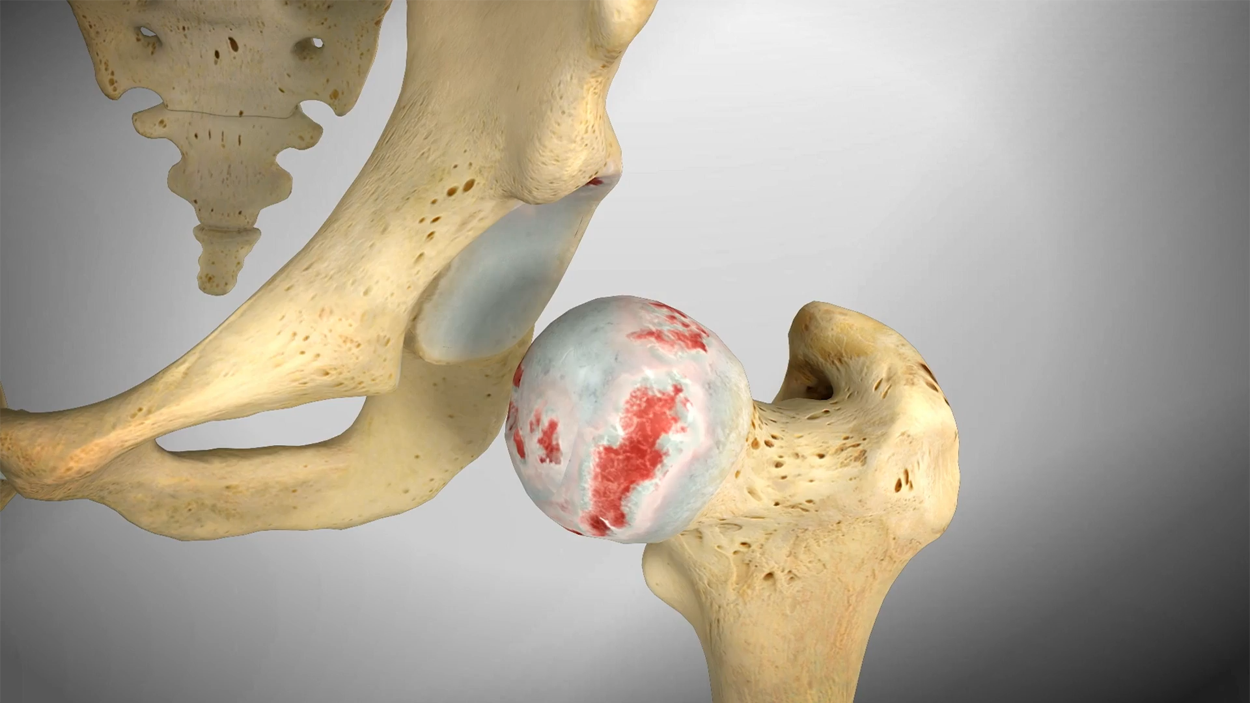 Understanding Hip Replacement Surgery