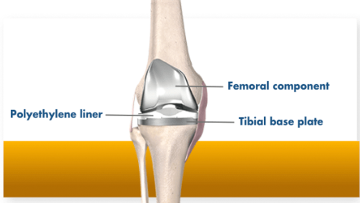 Muscle-sparing TKA with Mako
