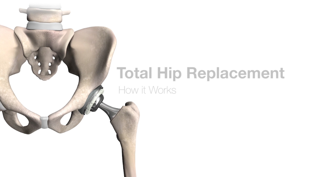 Minimally Invasive Hip Replacement