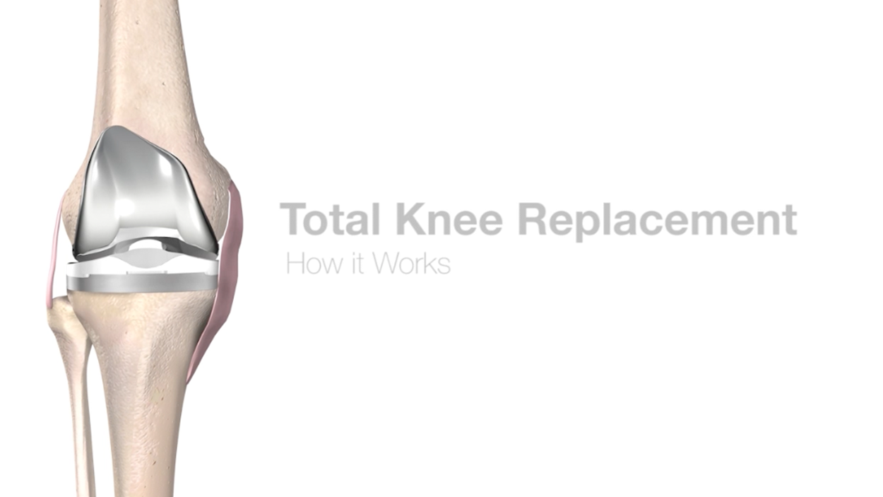 Mako Total Knee Replacement 