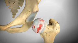 Understanding Hip Replacement Surgery