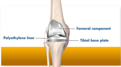 Muscle-sparing TKA with Mako