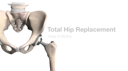 Minimally Invasive Hip Replacement