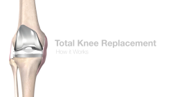 Mako Total Knee Replacement 